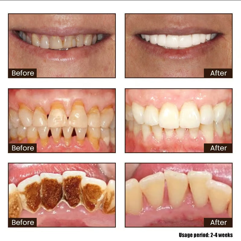 ⚡️Final Day 50% Rabatt: Niacinamid Whitening Toothpaste-max (👄Effektiv på en uke 丨Tripel Whitening & Tannflekkfjerning)