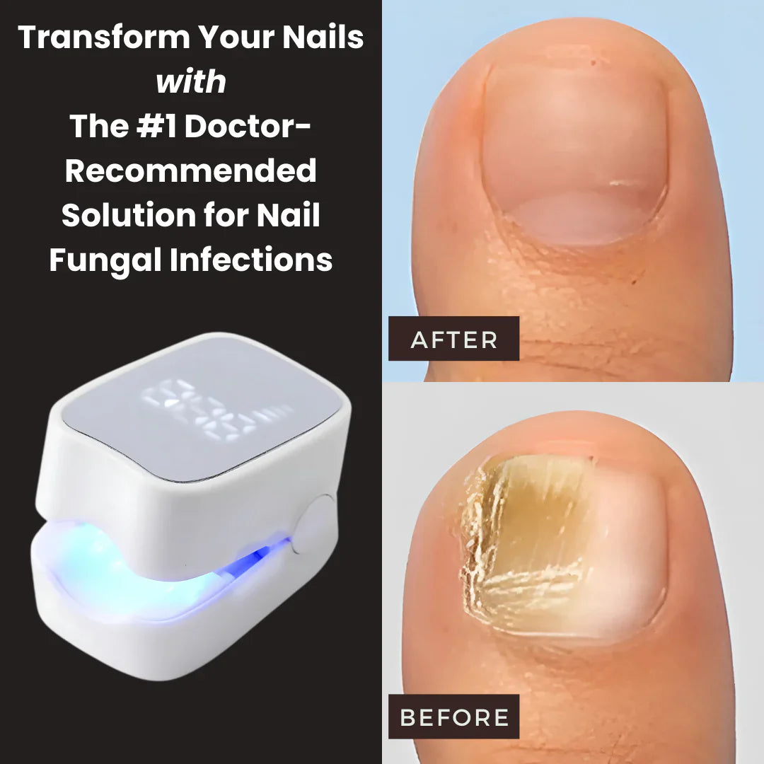 NailHeal Pro™ - Behandlingsapparat for neglesopp 🔥50% Rabatt