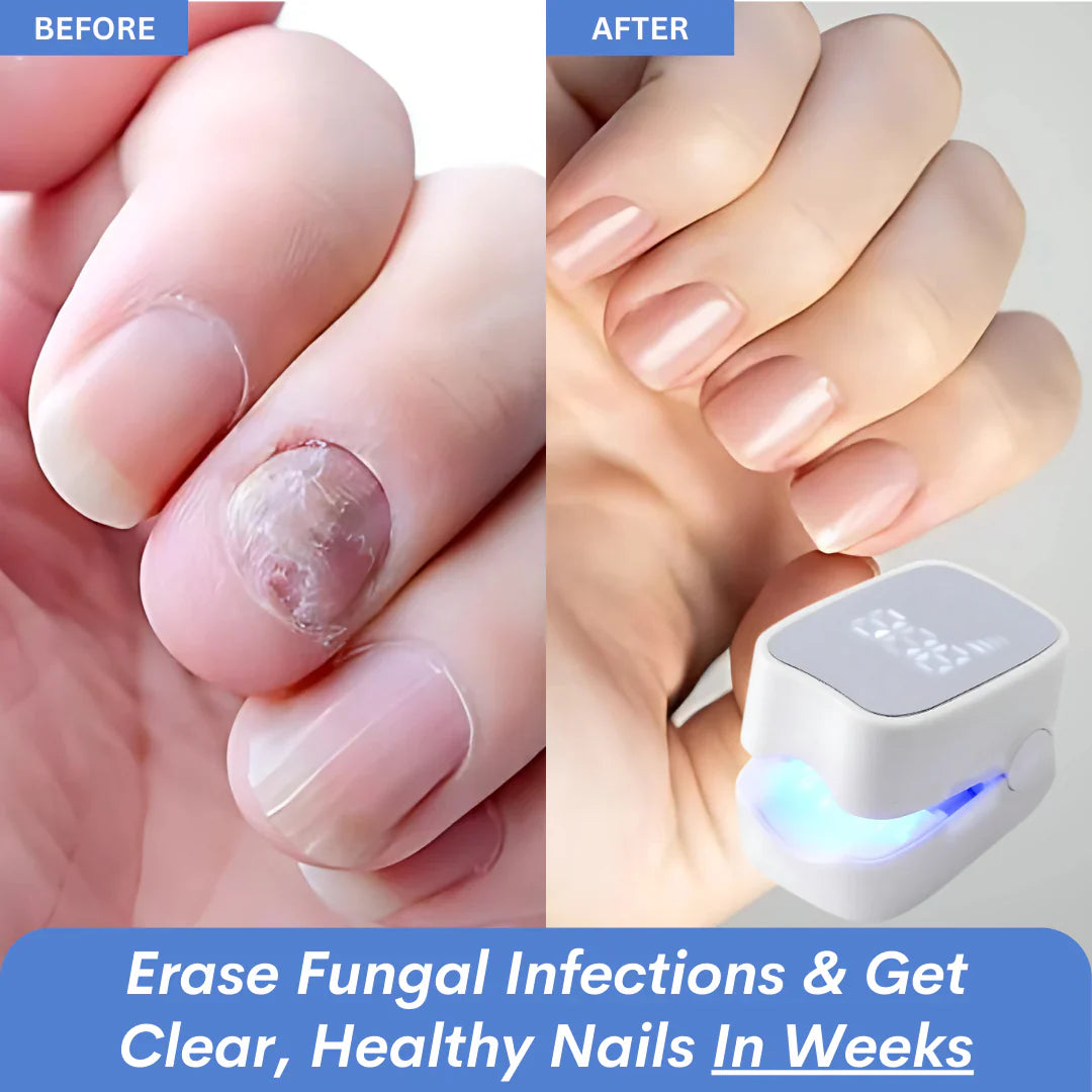 NailHeal Pro™ - Behandlingsapparat for neglesopp 🔥50% Rabatt