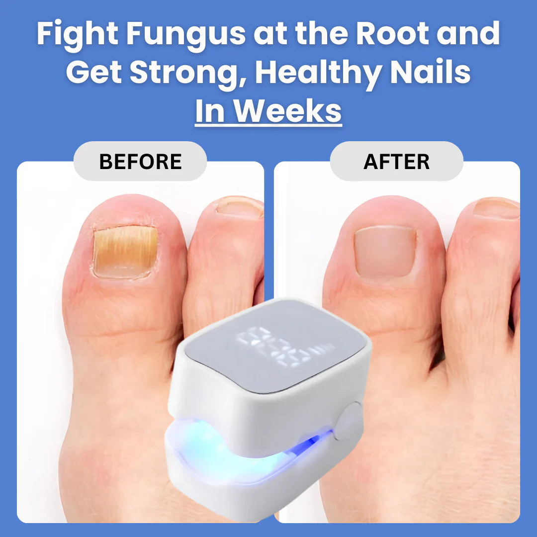NailHeal Pro™ - Behandlingsapparat for neglesopp 🔥50% Rabatt