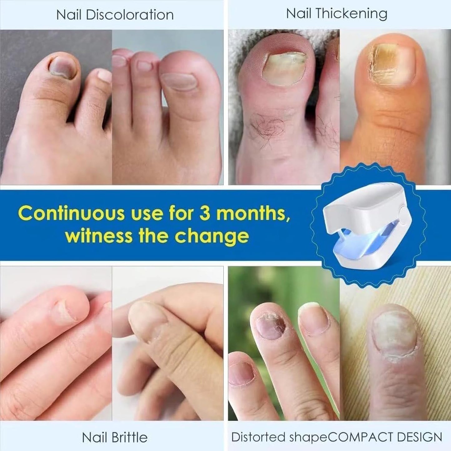 NailHeal Pro™ - Behandlingsapparat for neglesopp 🔥50% Rabatt