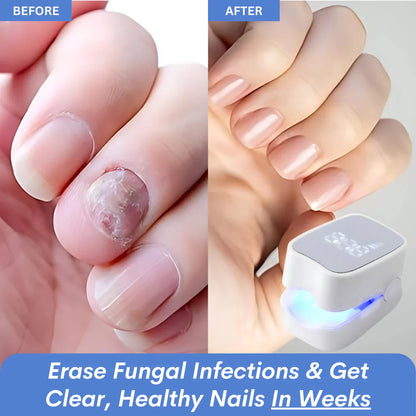 NailHeal Pro™ - Behandlingsapparat for neglesopp 🔥50% Rabatt